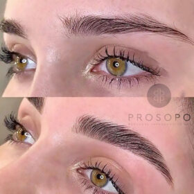 brow lift φρύδια πριν και μετά