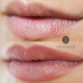 ενίσχυση χρώματος χειλιών με lip blush